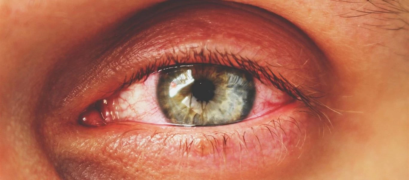 Επιπεφυκίτιδα: Οι 9+1 συμβουλές για να την αντιμετωπίσετε